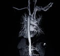 Ct scan angiogram (take photo from film x-ray) Royalty Free Stock Photo