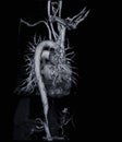 Ct scan angiogram (take photo from film x-ray)