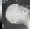 CT Scan Angles