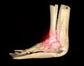 CT Scan ankle and foot