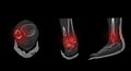 CT Scan ankle and foot or Computed Tomography of Ankle joint and Foot 3D Volume Rendering image showing fractured Tibia and fibula