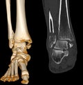 CT Scan ankle and foot or Computed Tomography of Ankle joint and Foot 3D Volume Rendering image showing fractured Tibia and fibula