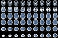 CT Scan brain acute on top subacute subdural hematoma SDH along left cerebral hemisphere,Education and medical healthcare