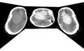 CT Scan Brain Axial scans with 5 mm slice thickness from OM-line to vertex