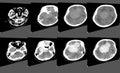 CT Scan Brain Axial scans with 5 mm slice thickness from OM-line to vertex