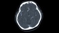 CT scan of the brain Axial view for diagnosis brain tumor,stroke diseases and vascular diseases