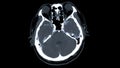 CT scan of the brain with injection contrast media  for diagnosis brain tumor,stroke diseases and vascular diseases Royalty Free Stock Photo