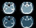 CT-Scan brain and orbit Impression: Rupture of Lt eye globe with Dislocation or destruction of the lens.Medical healthcare concept