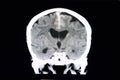 CT intracerebral hemorrhage