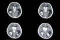 CT scan intracerebral hemorrhage