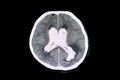 CT scan, intracecebral hemorrhage