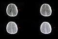 intracranial hemorrhage and brain edema