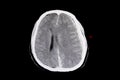 intracerebral hemorrhage and brain edema