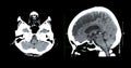 CT scan of the brain sagittal view for diagnosis brain tumor,stroke diseases and vascular diseases