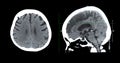 CT scan of the brain sagittal view for diagnosis brain tumor,stroke diseases and vascular diseases