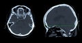 CT scan of the brain sagittal view for diagnosis brain tumor,stroke diseases and vascular diseases