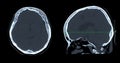 CT scan of the brain sagittal view for diagnosis brain tumor,stroke diseases and vascular diseases