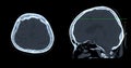 CT scan of the brain sagittal view for diagnosis brain tumor,stroke diseases and vascular diseases