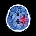 CT scan of brain show Ischemic Stroke or Hemorrhagic Stroke Royalty Free Stock Photo