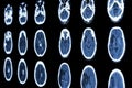 CT scan of brain show ischemic stroke and hemorrhagic stroke Royalty Free Stock Photo