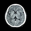 CT scan of brain : show normal human's brain ( CAT scan )