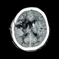 CT scan of brain : show old right basal ganglia hemorrhage with brain edema ( status post craniotomy ) ( Hemorrhagic stroke ) Royalty Free Stock Photo