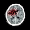 CT scan of brain : show old right basal ganglia hemorrhage with brain edema ( status post craniotomy ) ( Hemorrhagic stroke ) Royalty Free Stock Photo