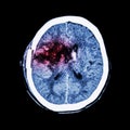 CT scan of brain : show old right basal ganglia hemorrhage with brain edema ( status post craniotomy ) ( Hemorrhagic stroke ) Royalty Free Stock Photo