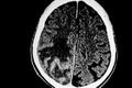 Ct Scan of brain showing a right tumor in the right cerebral hemisphere