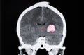 CT scan of the brain of a stroke patient Royalty Free Stock Photo