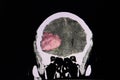 Brain CT scan, intracerebral hemorrhage Royalty Free Stock Photo