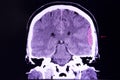 Brain CT scan, epidural hemorrhage
