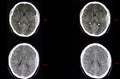 Brain CT scan, epidural hemorrhage