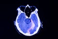 CT scan of a patient with traumatic brain injury