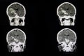 CT scan of a brian of a patient with acute hemorrhagic stroke