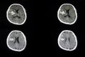 CT scan of a brian of a patient with acute hemorrhagic stroke