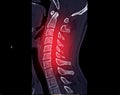 CT scan of C-Spine or Cervical spine Royalty Free Stock Photo