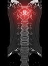 CT scan of C-Spine or Cervical spine Royalty Free Stock Photo