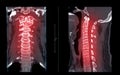 CT SCAN of Cervical Spine C-spine Royalty Free Stock Photo