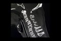 CT scan of fractures cervical spines