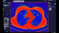 CT scan of Chest Axial view in color mode for diagnostic Pulmonary embolism (PE) , lung cancer and covid-19