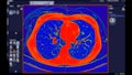 CT scan of Chest Axial view in color mode for diagnostic Pulmonary embolism (PE) , lung cancer and covid-19