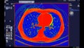 CT scan of Chest Axial view in color mode for diagnostic Pulmonary embolism (PE) , lung cancer and covid-19