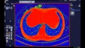 CT scan of Chest Axial view in color mode for diagnostic Pulmonary embolism (PE) , lung cancer and covid-19