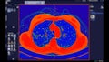 CT scan of Chest Axial view in color mode for diagnostic Pulmonary embolism (PE) , lung cancer and covid-19