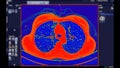 CT scan of Chest Axial view in color mode for diagnostic Pulmonary embolism (PE) , lung cancer and covid-19