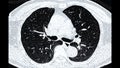 CT scan of Chest or lung axial view for screening lung nodules