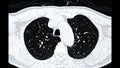 CT scan of Chest or lung axial view for screening lung nodules