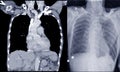 CT-Scan and Chest x-ray finding Interstitial pulmonary infiltration both lungs and Normal heart size and bony thorax.Medical