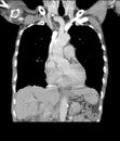 CT-Scan Chest finding Interstitial pulmonary infiltration both lungs and Normal heart size and bony thorax.Medical